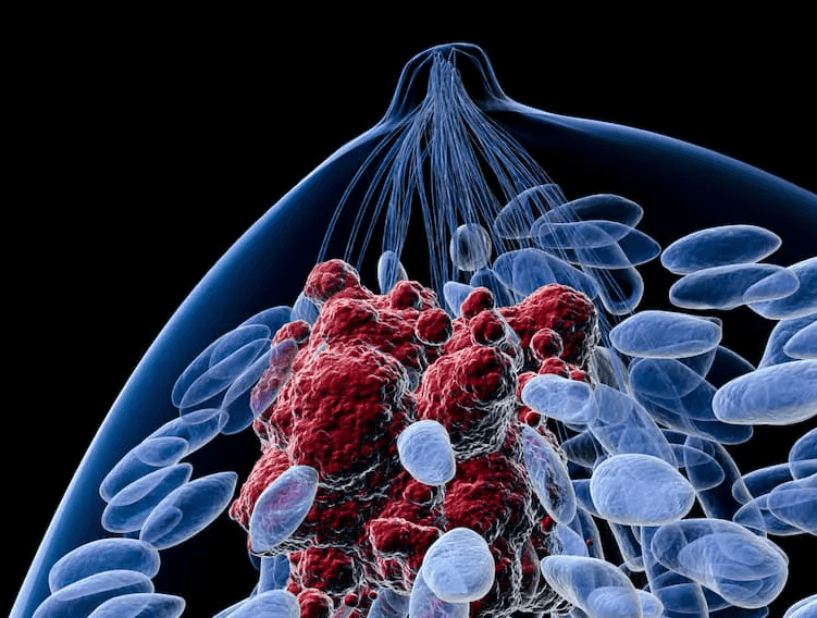 Anti-Tumor Treatment - Breast Cancer Case Studies