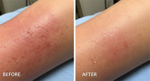 HBOT helps heal radiation burns in cancer patients